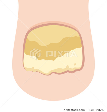 Onychomycosis and onychomycosis 130979692