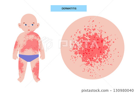 Dermatitis medical poster 130980040
