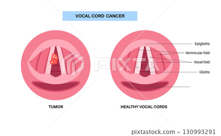 Vocal cord cancer medical poster Vocal cord cancer medical poster 130993291