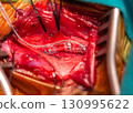 Close-up of a vagus nerve stimulation (VNS) surgical procedure, showcasing the exposed vagus nerve with an implanted stimulation lead in place. 130995622