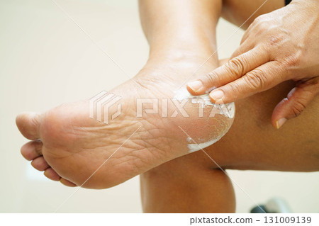 Asian woman check feet with crack and dry heel skin, Diabetic Foot. Asian woman check feet with crack and dry heel skin, Diabetic Foot. 131009139
