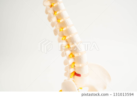 Spinal nerve and bone, Lumbar spine displaced herniated disc fragment, Model for treatment medical in the orthopedic department. Spinal nerve and bone, Lumbar spine displaced herniated disc fragment, Model for treatment medical in the orthopedic department. 131013594