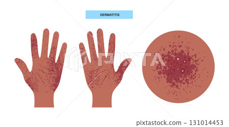 Dermatitis medical poster 131014453