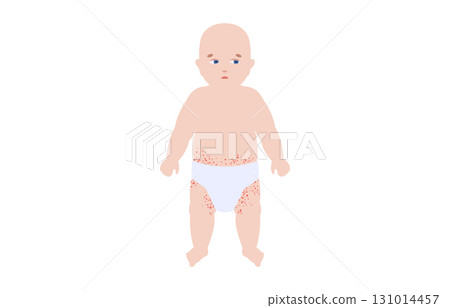 Diaper rash poster 131014457