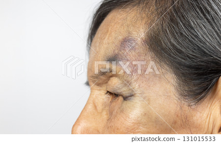 Elderly woman Have A Bruise on Face After Falling in Bathroom. 131015533