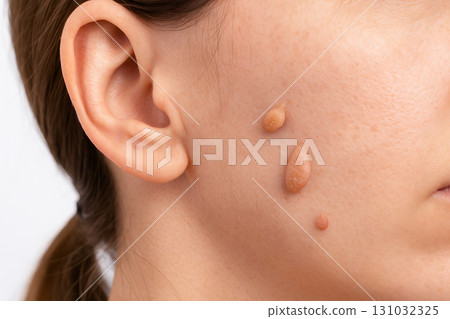 Close up of woman face with multiple papillomas on skin isolated on white background. Concept of skin disease, dermatology, viral infection, medical problem, diagnosis and treatment Close up of woman face with multiple papillomas on skin isolated on white background. Concept of skin disease, dermatology, viral infection, medical problem, diagnosis and treatment 131032325