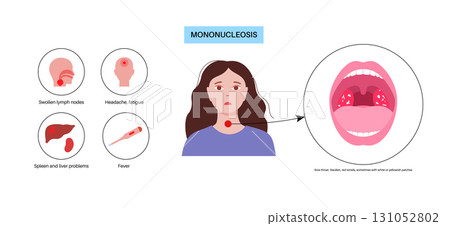 Mononucleosis symptoms poster Mononucleosis symptoms poster 131052802