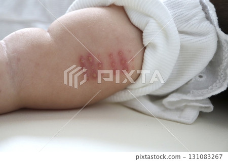 Reaction and scab on baby's arm one month after BCG vaccination 131083267