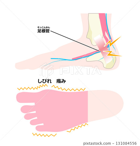 tarsal tunnel syndrome tarsal tunnel syndrome 131084556