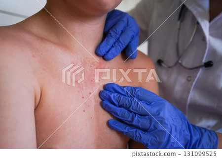 The boy's skin shows a rash consistent with allergic dermatitis. The boy's skin shows a rash consistent with allergic dermatitis. 131099525