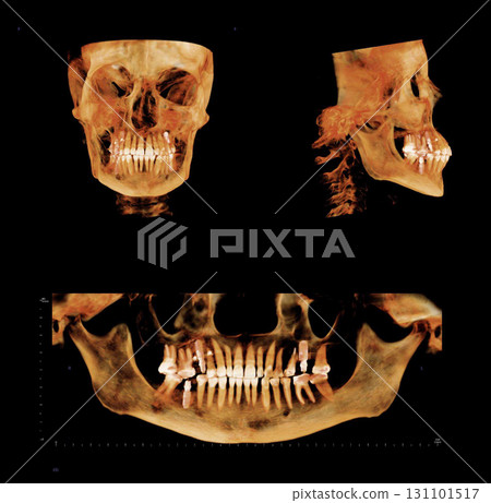 Computed tomography of adult female patient with dental root and implant treatments. Dental x-ray of an adult patient showing teeth, jaws and a dental implant. Modern digital tomography for dentistry 131101517