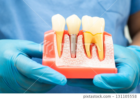 Dentist holding dental implant, artificial tooth roots into jaw, root canal of dental treatment, gum disease, teeth model for dentist. Dentist holding dental implant, artificial tooth roots into jaw, root canal of dental treatment, gum disease, teeth model for dentist. 131105558