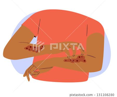 Cartoon Illustration Of Person Scratching Arms With Eczema Allergy 131108280