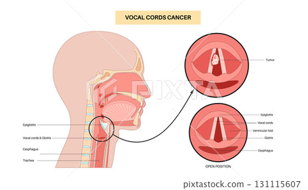 Vocal cord cancer medical poster 131115607