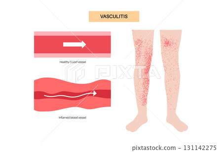 Vasculitis medical poster 131142275