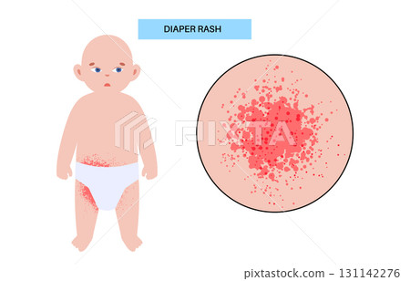Diaper rash poster 131142276