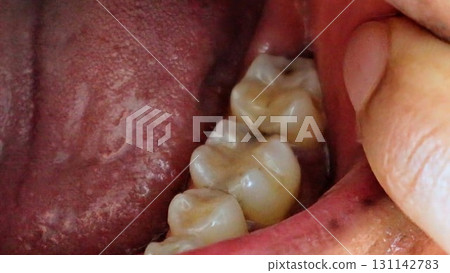 Close-up of a decayed tooth 131142783