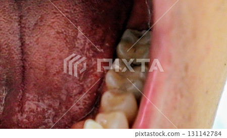 後牙蛀牙 131142784