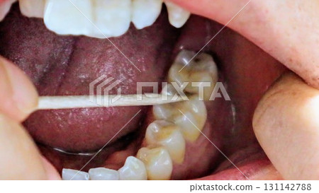 一個人用牙籤觸碰蛀牙 131142788