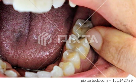 觸摸腐爛的臼齒 觸摸腐爛的臼齒 131142789