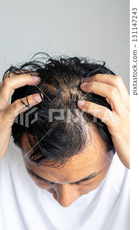 A young man's head concerned about thinning hair (AI-generated image) 131147243