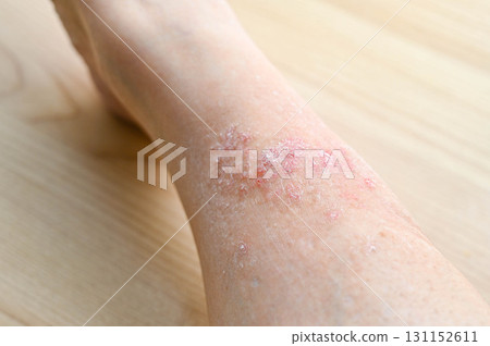 足部濕疹 足部濕疹 131152611