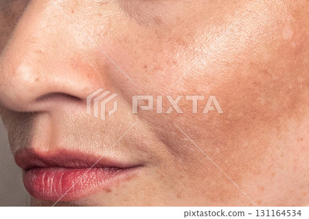 Cropped close up photo Woman with pigmentation, melasma, freckles, age spots photo. 131164534