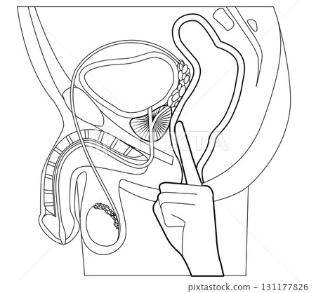 前列腺按摩體位 131177826