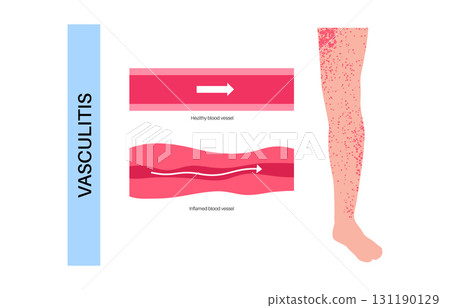 Vasculitis medical poster Vasculitis medical poster 131190129
