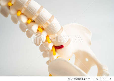 Spinal nerve and bone, Lumbar spine displaced herniated disc fragment, Model for treatment medical in the orthopedic department. Spinal nerve and bone, Lumbar spine displaced herniated disc fragment, Model for treatment medical in the orthopedic department. 131192903
