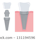 Dental implant. Screw prosthesis, Illustration of dental implantation,orthodontic dental implantation 131194596