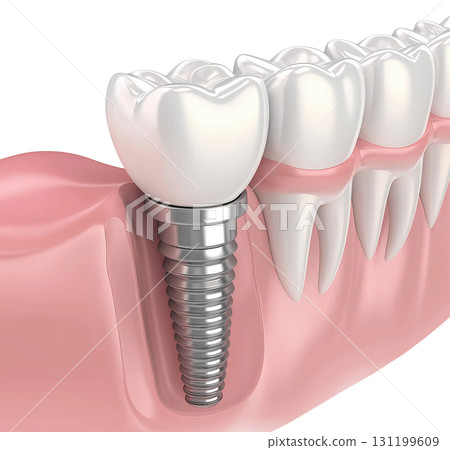 Dental Implant Illustration Dental Implant Illustration 131199609
