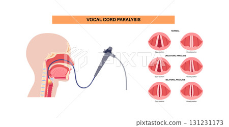 Vocal cords paralysis 131231173