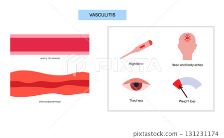 Vasculitis medical poster 131231174