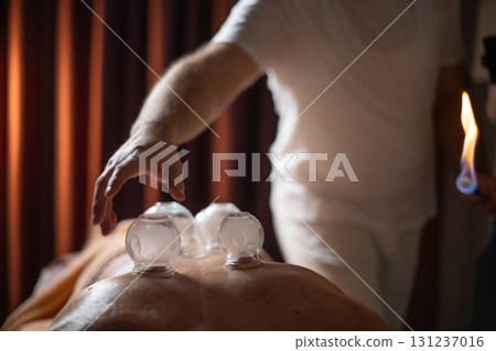 Close up of a traditional fire cupping therapy session with glass cups placed on a patients back and therapist using fire to create suction, promoting relaxation and healing. 131237016