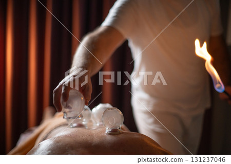 Close up of a traditional fire cupping therapy session with glass cups placed on a patients back and therapist using fire to create suction, promoting relaxation and healing. 131237046