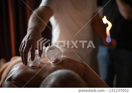 Close up of a traditional fire cupping therapy session with glass cups placed on a patients back and therapist using fire to create suction, promoting relaxation and healing. 131237052