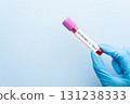 Blood sample tube with Alzheimer test label on medical laboratory technologist hands over blue background. A blood test that can help detect early signs of Alzheimer disease. 131238333