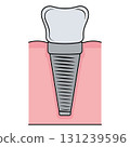 Dental implant. Screw prosthesis, Illustration of dental implantation,orthodontic dental implantation 131239596