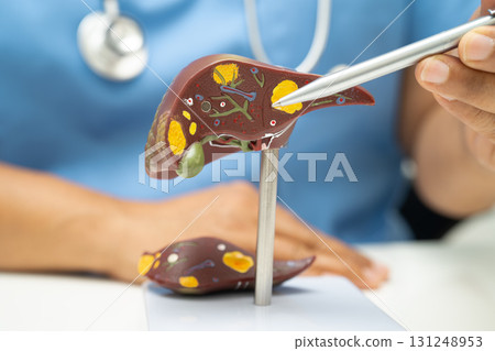 Cirrhosis, Liver cancer, fatty liver, Asian doctor with liver human anatomy model in World Hepatitis Day at hospital. 131248953