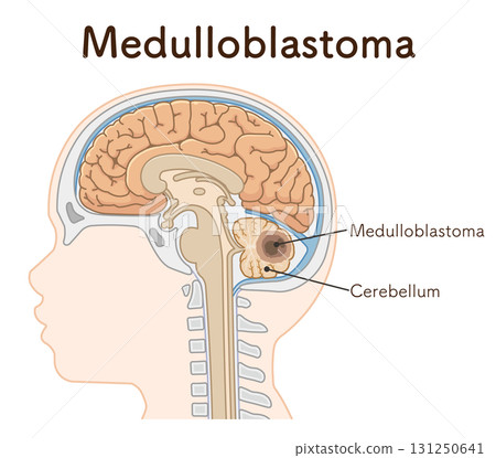 Childhood brain tumors 131250641