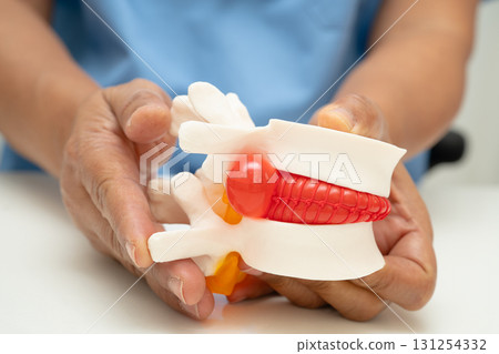 Asian doctor holding spinal nerve and bone model, Lumbar spine displaced herniated disc fragment for treatment medical in the orthopedic department. 131254332