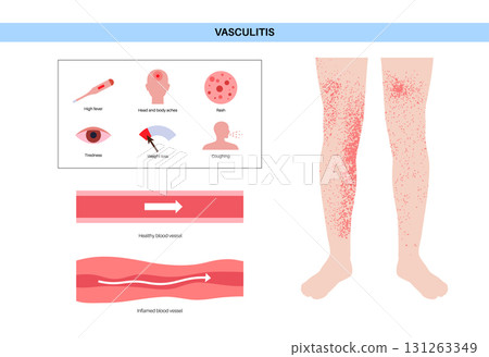 Vasculitis medical poster 131263349