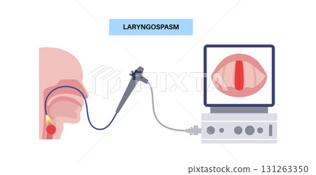 Laryngospasm medical poster 131263350