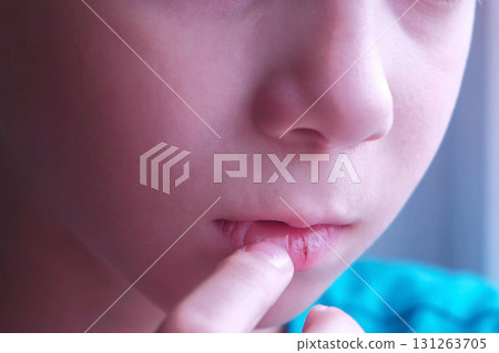 Child boy with herpes sore on the lip louches his lip, mouth closeup. Child boy with herpes sore on the lip louches his lip, mouth closeup. 131263705