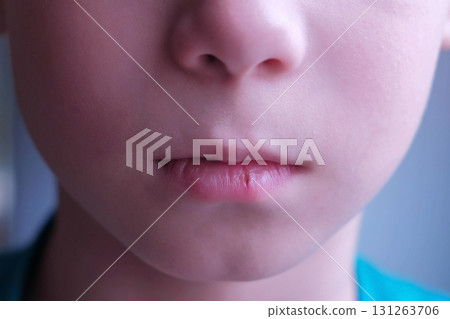 Child boy with herpes sore on the lip, mouth closeup. 131263706