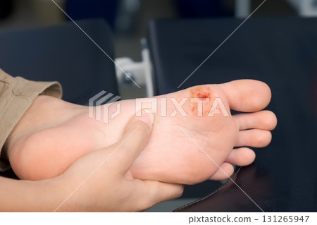 Wound of removed wart after laser removal on patient boy's foot, closeup view. 131265947
