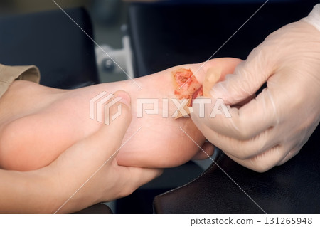 Surgeon is changing the wound on boy's foot with a plaster after the operation. 131265948