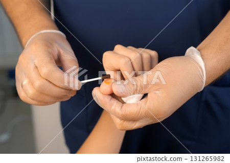 Surgeon is applying iodine on wound after laser removal os wart on thumb. Surgeon is applying iodine on wound after laser removal os wart on thumb. 131265982