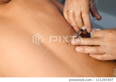 Surgeon gives injection of local anesthesia during laser removing mole on back. 131265997